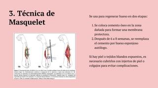 Se usa para regenerar hueso en dos etapas:
Se coloca cemento óseo en la zona
dañada para formar una membrana
protectora.
1.
Después de 6 a 8 semanas, se reemplaza
el cemento por hueso esponjoso
autólogo.
2.
Si hay piel o tejidos blandos expuestos, es
necesario cubrirlos con injertos de piel o
colgajos para evitar complicaciones.
3. Técnica de
Masquelet
 