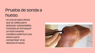 Prueba de sonda a
hueso.
es una prueba clínica
que se utiliza para
detectar osteomielitis.
Consiste en introducir
un instrumento
metálico estéril en una
úlcera para
comprobar si se
alcanza el hueso
 
