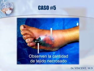 CASO #5Observen la cantidadde tejido necrosado Dr. VINCENT,  M.D