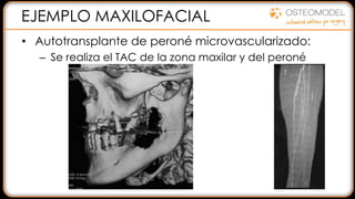 EJEMPLO MAXILOFACIAL
• Autotransplante de peroné microvascularizado:
– Se realiza el TAC de la zona maxilar y del peroné
 