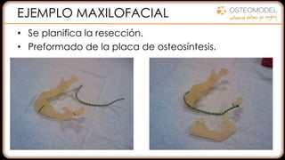 EJEMPLO MAXILOFACIAL
• Se planifica la resección.
• Preformado de la placa de osteosíntesis.
 