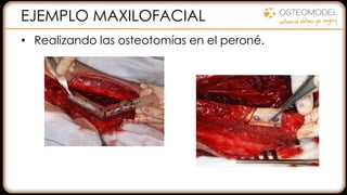 EJEMPLO MAXILOFACIAL
• Realizando las osteotomías en el peroné.
 