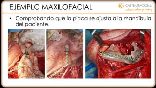 EJEMPLO MAXILOFACIAL
• Comprobando que la placa se ajusta a la mandíbula
del paciente.
 