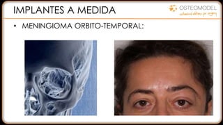 IMPLANTES A MEDIDA
• MENINGIOMA ORBITO-TEMPORAL:
 