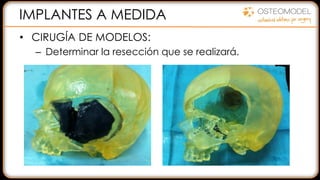 IMPLANTES A MEDIDA
• CIRUGÍA DE MODELOS:
– Determinar la resección que se realizará.
 