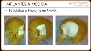 IMPLANTES A MEDIDA
• Se fabrica el implante en PMMA.
 