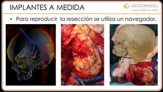 IMPLANTES A MEDIDA
• Para reproducir la resección se utiliza un navegador.
 