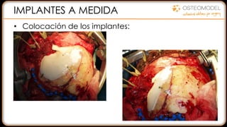 IMPLANTES A MEDIDA
• Colocación de los implantes:
 