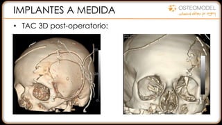 IMPLANTES A MEDIDA
• TAC 3D post-operatorio:
 