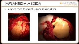 IMPLANTES A MEDIDA
• 2 años más tarde el tumor se recidiva.
 