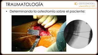 TRAUMATOLOGÍA
• Determinando la osteotomía sobre el paciente:
 