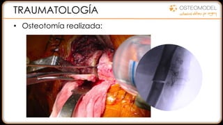 TRAUMATOLOGÍA
• Osteotomía realizada:
 