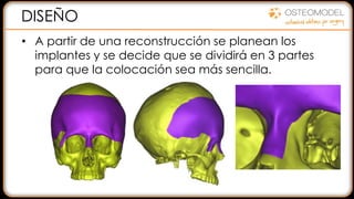 DISEÑO
• A partir de una reconstrucción se planean los
implantes y se decide que se dividirá en 3 partes
para que la colocación sea más sencilla.
 