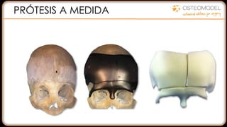 PRÓTESIS A MEDIDA
 