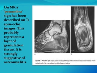 Osteomyelitis