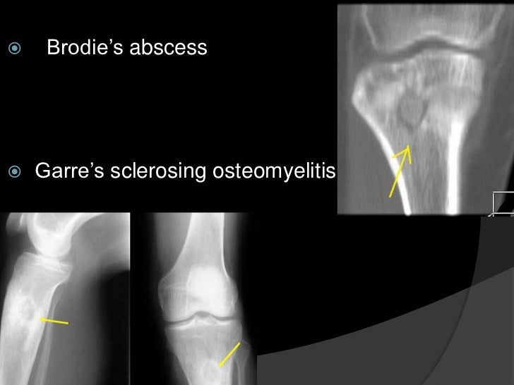 Osteomyelitis
