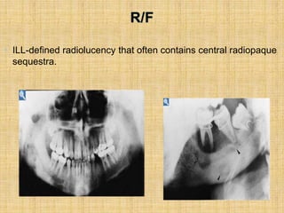 • ILL-defined radiolucency that often contains central radiopaque
sequestra.
 