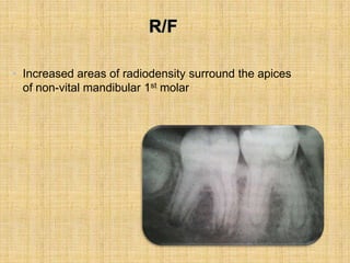 • Increased areas of radiodensity surround the apices
of non-vital mandibular 1st molar
 
