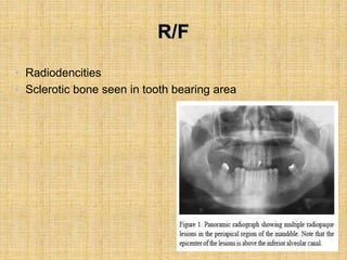• Radiodencities
• Sclerotic bone seen in tooth bearing area
 