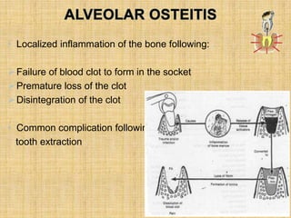 • Localized inflammation of the bone following:
Failure of blood clot to form in the socket
Premature loss of the clot
Disintegration of the clot
• Common complication following
tooth extraction
 