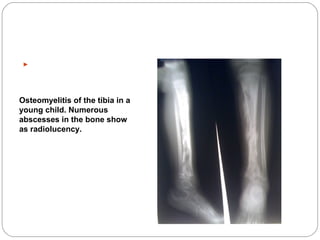 Tibia Abscess Osteomyelitis | PPT