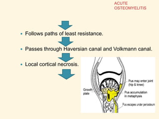  Follows paths of least resistance.
 Passes through Haversian canal and Volkmann canal.
 Local cortical necrosis.
ACUTE
OSTEOMYELITIS
 