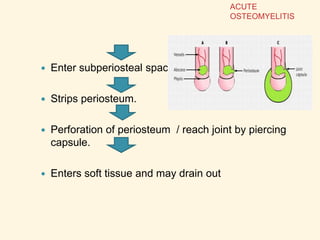  Enter subperiosteal space.
 Strips periosteum.
 Perforation of periosteum / reach joint by piercing
capsule.
 Enters soft tissue and may drain out
ACUTE
OSTEOMYELITIS
 