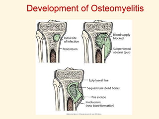 Development of Osteomyelitis
 