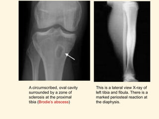 A circumscribed, oval cavity
surrounded by a zone of
sclerosis at the proximal
tibia (Brodie’s abscess)
This is a lateral view X-ray of
left tibia and fibula. There is a
marked periosteal reaction at
the diaphysis.
 