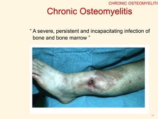 Chronic Osteomyelitis
“ A severe, persistent and incapacitating infection of
bone and bone marrow ”
35
CHRONIC OSTEOMYELITIS
 