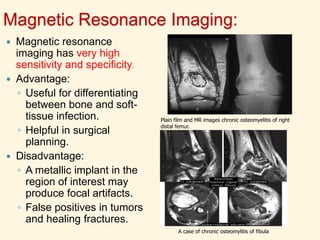 AP & lateral view of the left wrist show a lobulated osteolytic lesion with
well-defined borders and surrounding sclerosis at the distal radius.
Minimal expansion, mild periosteal reaction and soft tissue swelling are
present.
CHRONIC OSTEOMYELITIS
 