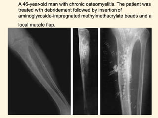 Treatment -
Antibiotics
- Chronic infection is seldom eradicated by
antibiotics alone.
- Bactericidal drugs are important to:
a) Stop the spread of infection to healthy bone
b) Control acute flares
- Antibiotics used in treating chronic osteomyelitis
(Fusidic acid, Clindamycin, Vancomycin,
Cefazolin)
65
CHRONIC OSTEOMYELITIS
 