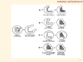 Antibiotic
choice
 Guided by microbiology department
 Clindamycin (98% serum level) and
vancomycin(14% serum level) have good bone
penetration
 Minimum length 6 weeks with 3 months being the
standard treatment course
 May need to treat for 6-12 months
66
CHRONIC OSTEOMYELITIS
 
