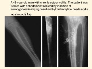 A 46-year-old man with chronic osteomyelitis. The patient was
treated with debridement followed by insertion of
aminoglycoside-impregnated methylmethacrylate beads and a
local muscle flap.
 