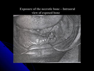 Osteomyelitis | PPT