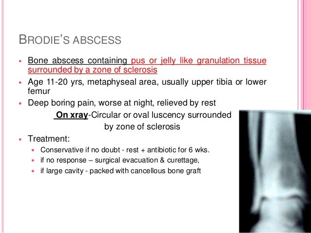 Osteomyelitis
