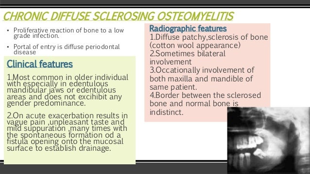 Osteomyelitis