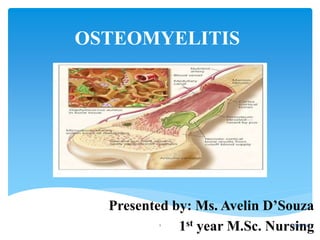 OSTEOMYELITIS
Presented by: Ms. Avelin D’Souza
1st year M.Sc. Nursing5/30/20161
 