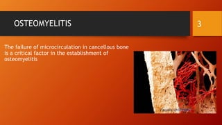 OSTEOMYELITIS
The failure of microcirculation in cancellous bone
is a critical factor in the establishment of
osteomyelitis
3
 