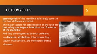 OSTEOMYELITIS
osteomyelitis of the mandible also rarely occurs if
the host defenses are intact.
The major factors for osteomyelitis of the jaws are
preceding odontogenic infections and fractures
of the mandible.
And they are suppressed by such problems
as diabetes, alcoholism, intravenous drug
abuse, malnutrition, and myeloproliferative
diseases.
5
 
