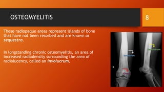 OSTEOMYELITIS
These radiopaque areas represent islands of bone
that have not been resorbed and are known as
sequestra.
In longstanding chronic osteomyelitis, an area of
increased radiodensity surrounding the area of
radiolucency, called an involucrum,
8
 