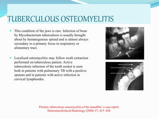 TUBERCULOUS OSTEOMYELITIS
 This condition of the jaws is rare. Infection of bone
by Mycobacterium tuberculosis is usually brought
about by hematogenous spread and is almost always
secondary to a primary focus in respiratory or
alimentary tract.
 Localised osteomyelitis may follow tooth extraction
performed on tuberculous patient. Active
tuberculosis infection of the tooth socket is seen
both in patients with pulmonary TB with a positive
sputum and in patients with active infection in
cervical lymphnodes.
Primary tuberculous osteomyelitis of the mandible: a case report
Dentomaxillofacial Radiology (2008) 37, 415–420
 