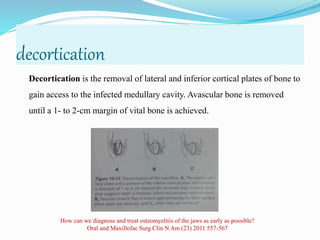 decortication
Decortication is the removal of lateral and inferior cortical plates of bone to
gain access to the infected medullary cavity. Avascular bone is removed
until a 1- to 2-cm margin of vital bone is achieved.
How can we diagnose and treat osteomyelitis of the jaws as early as possible?
Oral and Maxillofac Surg Clin N Am (23) 2011 557-567
 