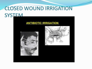 CLOSED WOUND IRRIGATION
SYSTEM
 