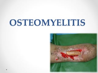 OSTEOMYELITIS
 