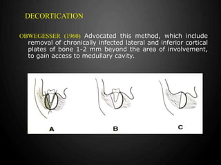 Osteomyelitis | PPTX