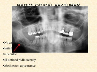 RADIOLOGICAL FEATURES
No early changes
Initial changes include blurring of the bony
trabeculae
Ill defined radiolucency
Moth eaten appearance
 