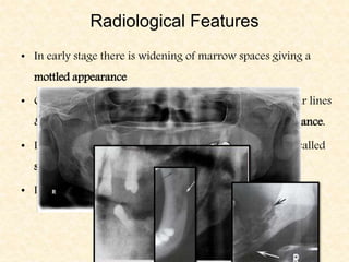 Radiological Features
• In early stage there is widening of marrow spaces giving a
mottled appearance
• Granulation tissue b/w dead & living bone gives irregular lines
& zones of radiolucency resulting in moth -eaten appearance.
• In later stages the devitalized bone appears sclerosed & called
sequestrum.
• Large areas of bone destruction seen as radiolucent areas.
 