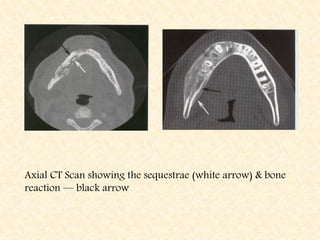 Axial CT Scan showing the sequestrae (white arrow) & bone
reaction — black arrow
 