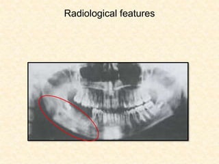Radiological features
 
